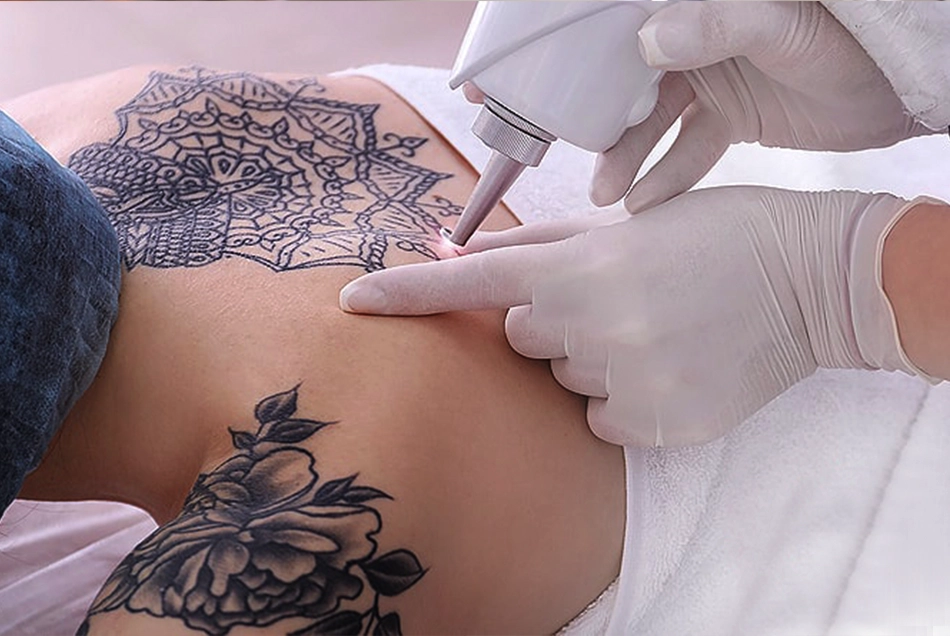 A woman getting her tattoo removed through laser